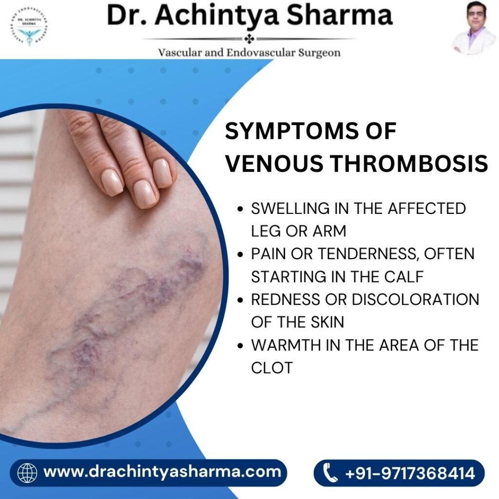 Symptoms of Venous Thrombosis