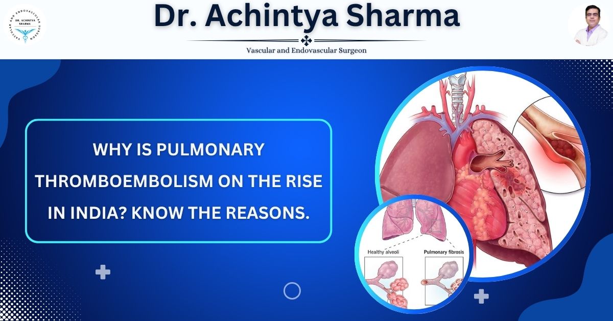 Why is Pulmonary Thromboembolism on the rise in India? Know the reasons
