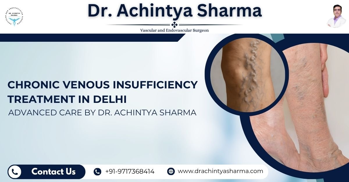 Read more about the article Chronic Venous Insufficiency Treatment in Delhi: Advanced Care by Dr. Achintya Sharma