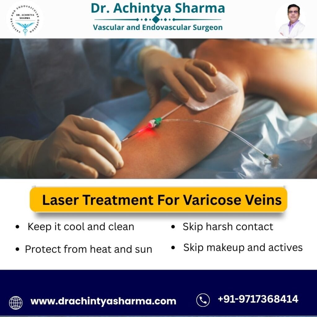 Laser Treatment For Varicose Veins