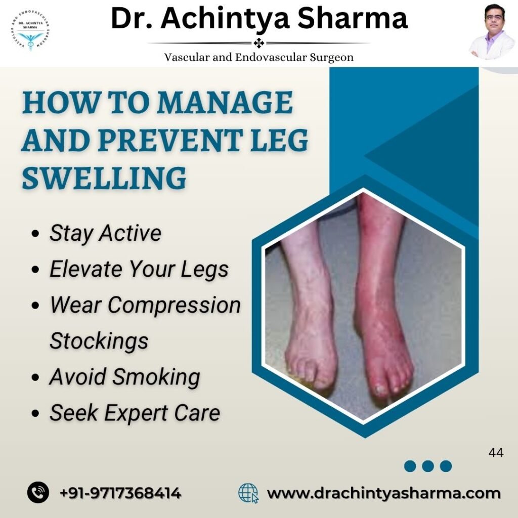 How to Manage and Prevent Leg Swelling