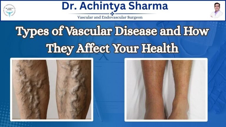 Read more about the article Types of Vascular Disease and How They Affect Your Health 