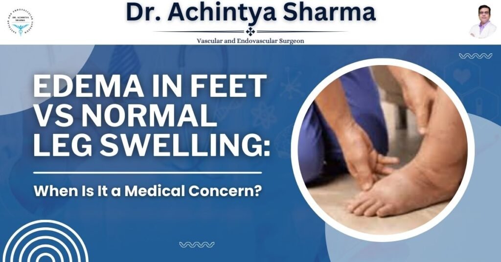 Why do people often ignore edema in feet?