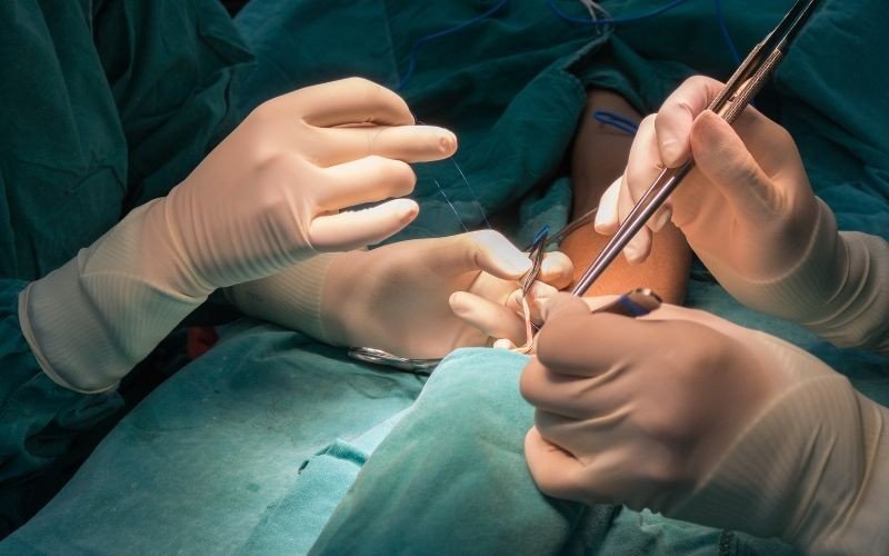 AV fistula surgery