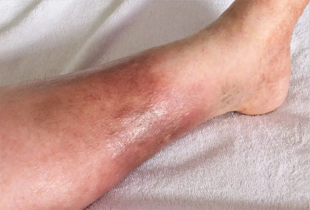 Vascular treatment