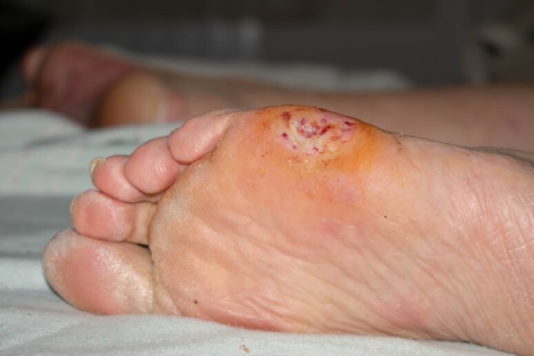 Diabetic foot care